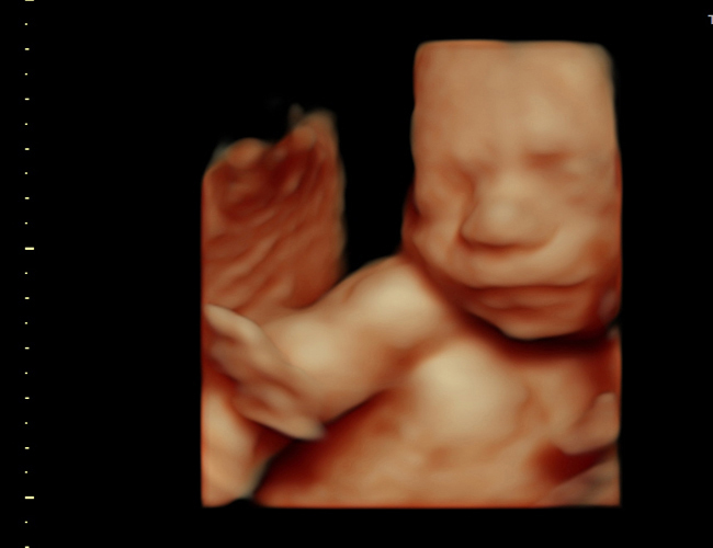 3D ultrasound image at 25 weeks